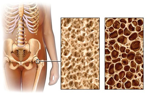 Osteoporosis: Causes, Diagnosis and Prevention